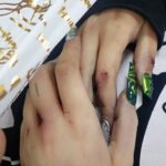 Случаят с 16-г. Ивана паднала от балкон в Благоевград се заплита: Баща й показа снимки със следи от насилие