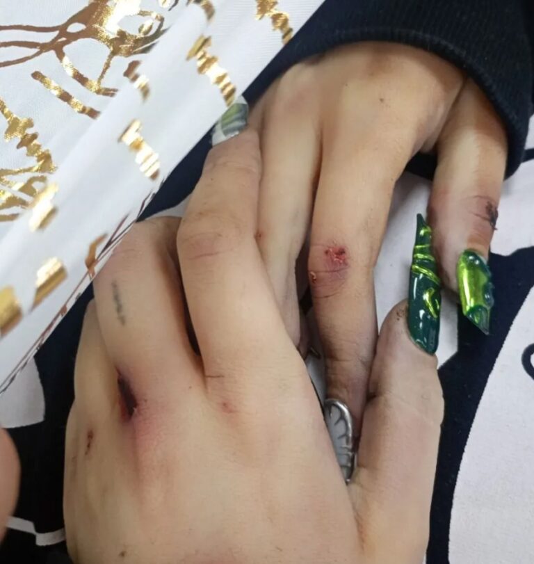Случаят с 16-г. Ивана паднала от балкон в Благоевград се заплита: Баща й показа снимки със следи от насилие Случаят с 16-г. Ивана паднала от балкон в Благоевград се заплита: Баща й показа снимки със следи от насилие